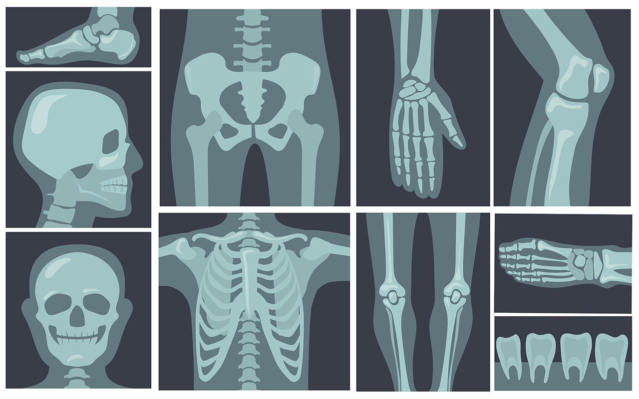 Liikunnan Puutteesta Riippumatta: Arkeologinen Löytö Osoittaa, Että Luiden Heikkous On Ikiaikainen Ilmiö, Tutkimuksen Mukaan.